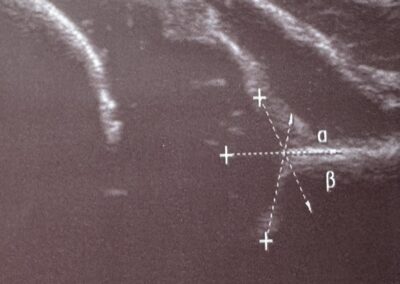 Sonografie und Hüftultraschall bei Neugeborenen